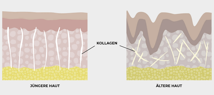 Kollagen in der Haut eines älteren und jüngeren Menschen (Illustration)